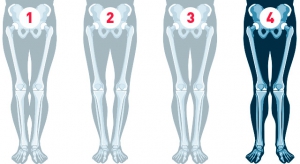 Knock knees (valgus deformity) correction